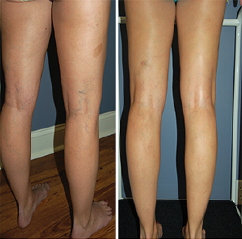 Sclerotherapy: Before and After (1)