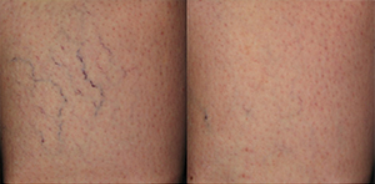Sclerotherapy: Before and After (2)